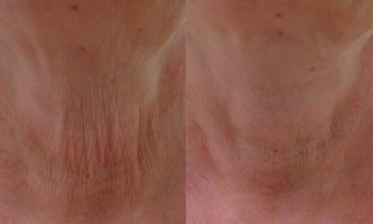 Harmony Before & After