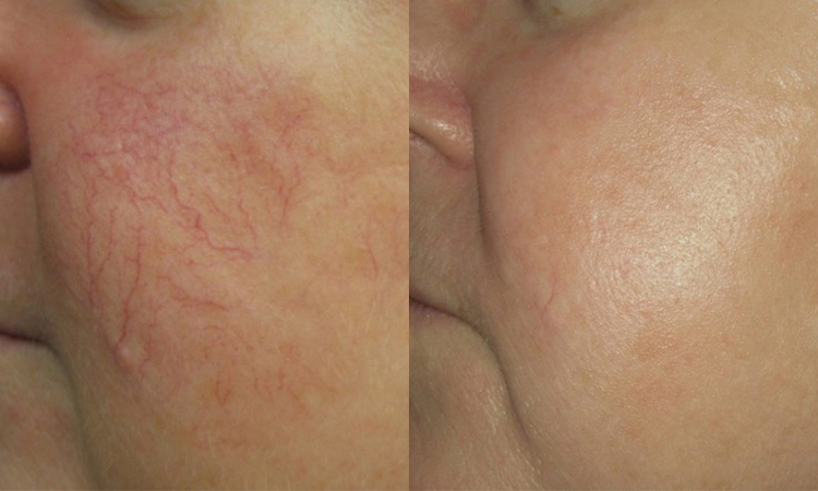 Harmony Before & After
