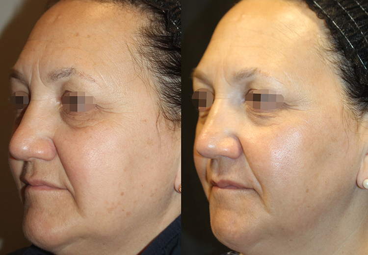 Alma Hybrid Before & After